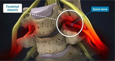 Symptoms of spinal stenosis